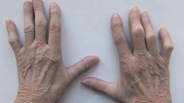 Méthodes pour traiter la douleur dans les articulations des doigts